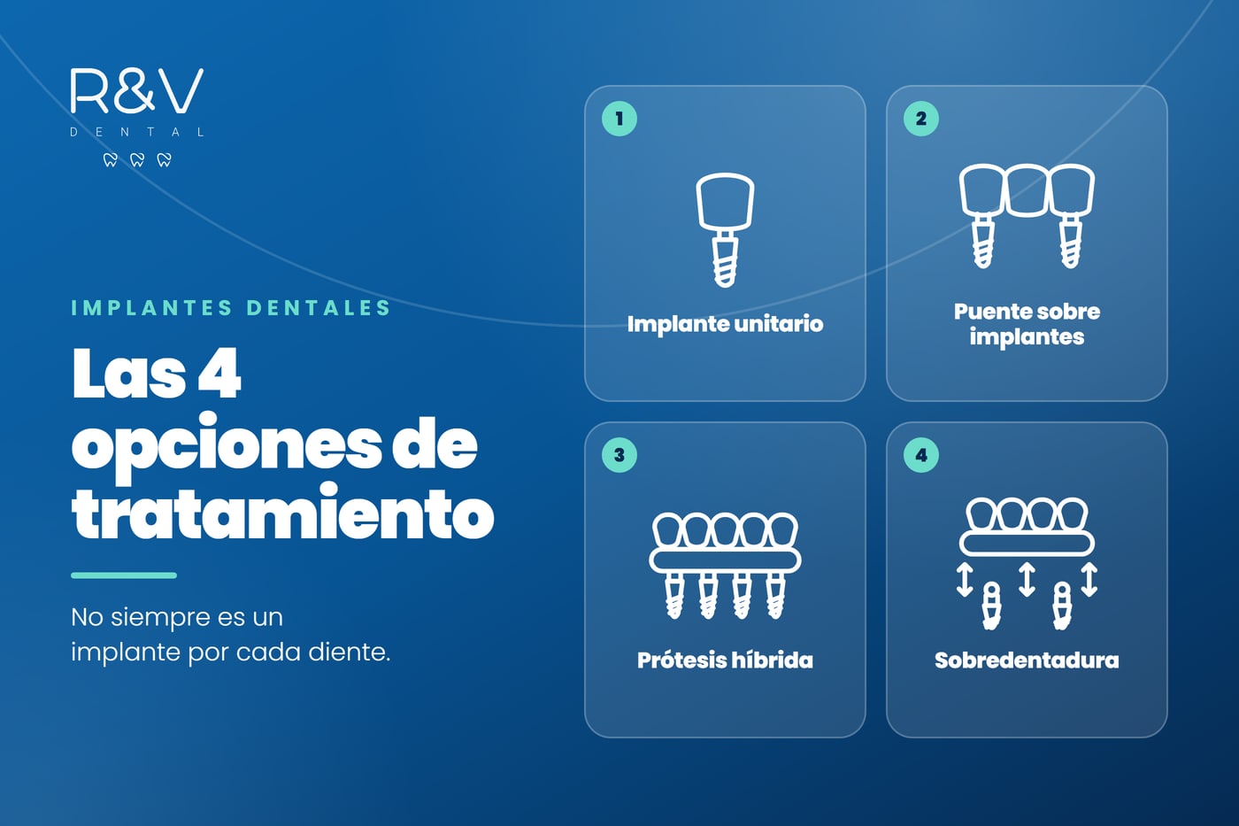 Implantes dentales: las 4 opciones de tratamiento y cómo saber cuál es la indicada