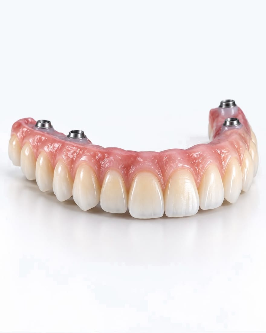 Prótesis híbrida fija de arcada completa sobre implantes dentales