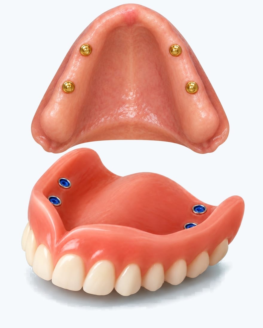 Sobredentadura de acrílico con anclajes que se abrochan a los implantes dentales