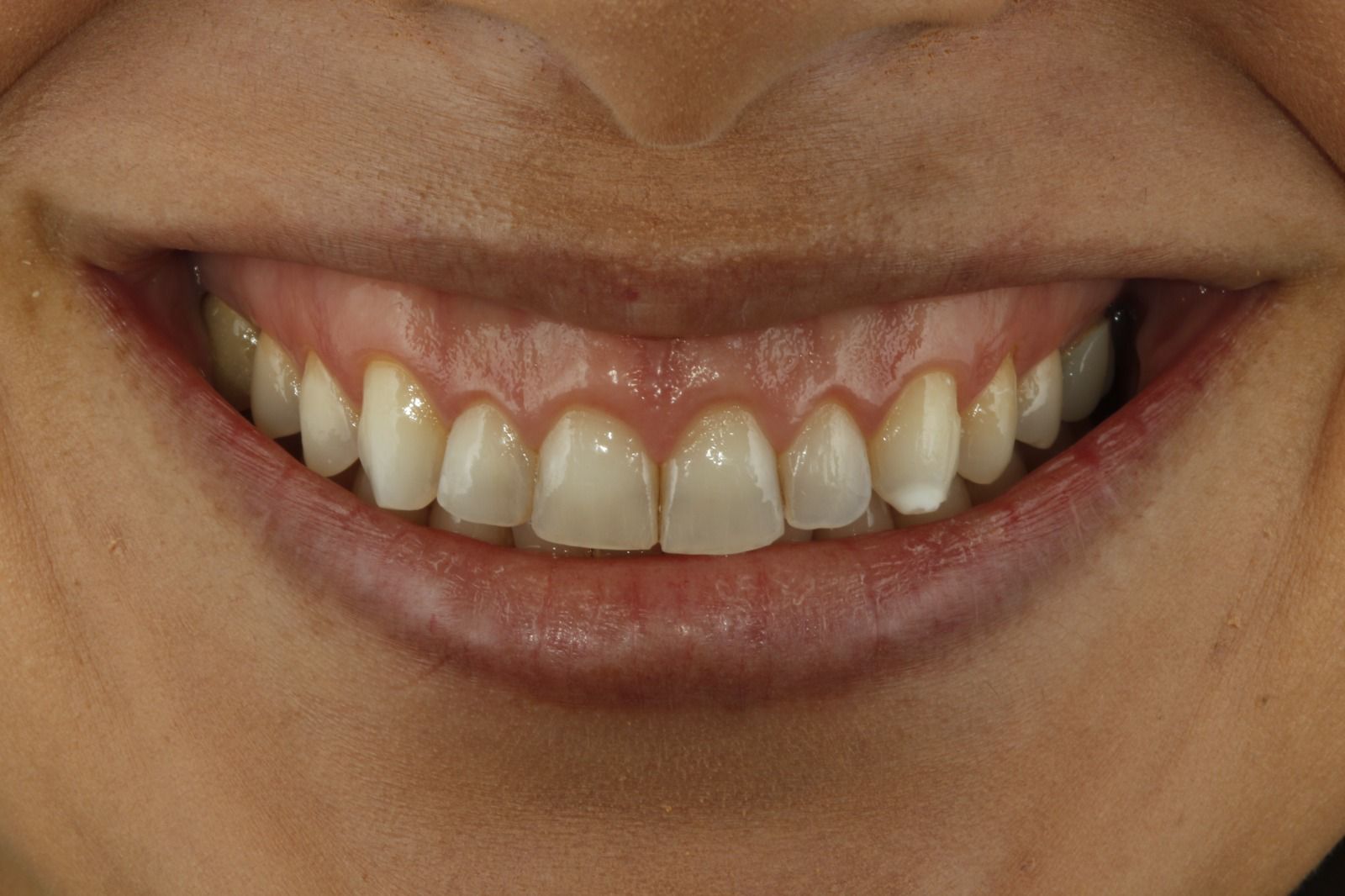 Después del tratamiento dental RyV Dental