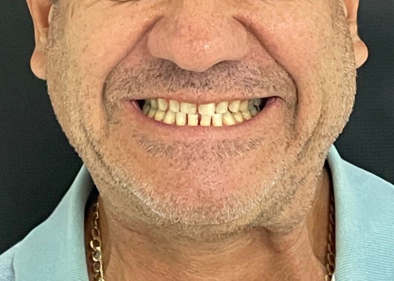 Después de rehabilitación estética RyV Dental