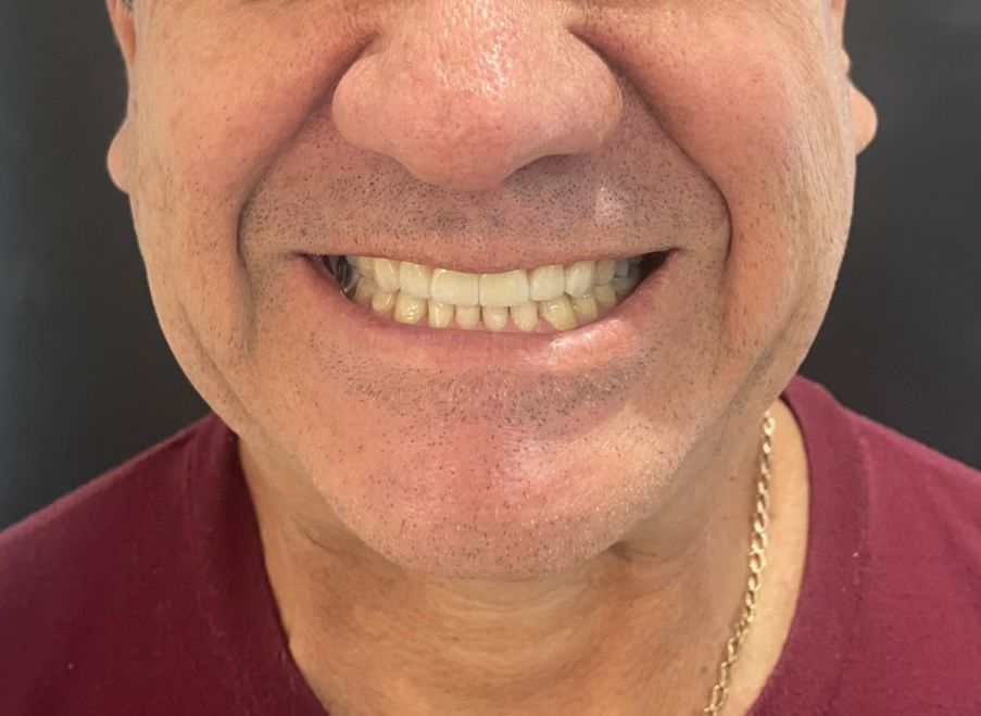 Antes de rehabilitación estética RyV Dental