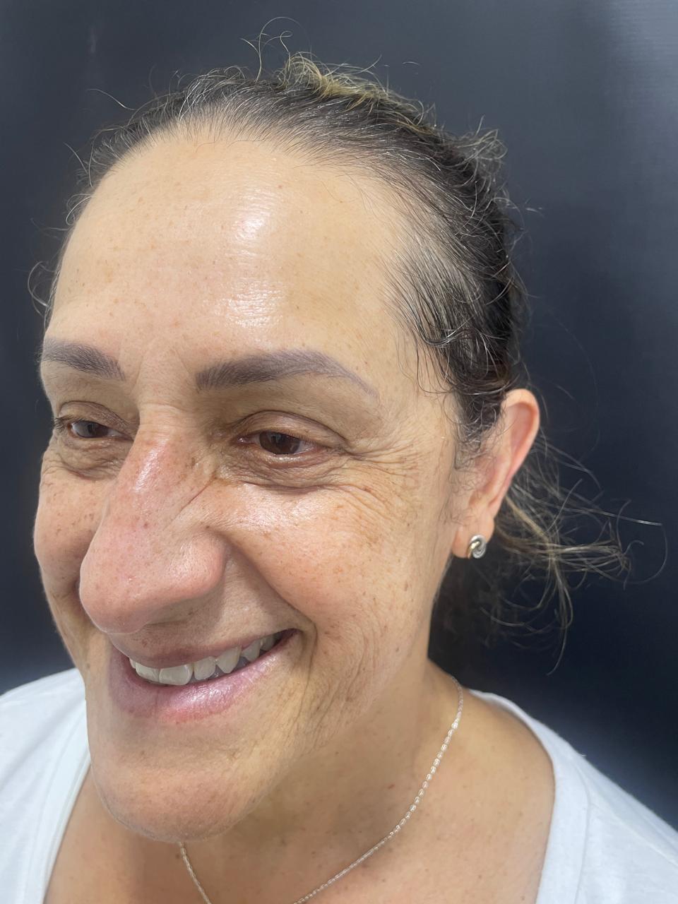 Antes de Botox en patas de gallo RyV Dental