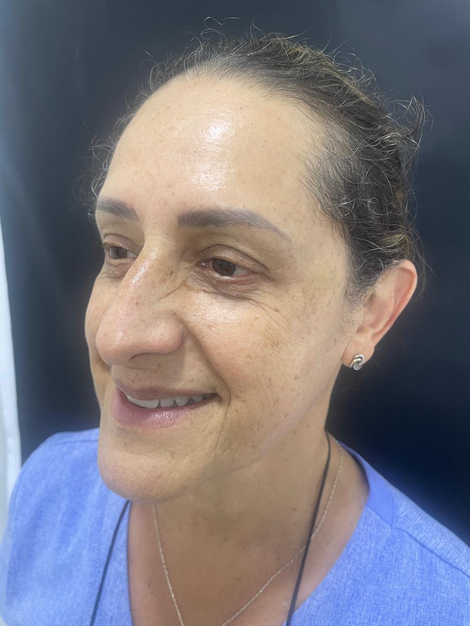 Después de Botox en patas de gallo RyV Dental