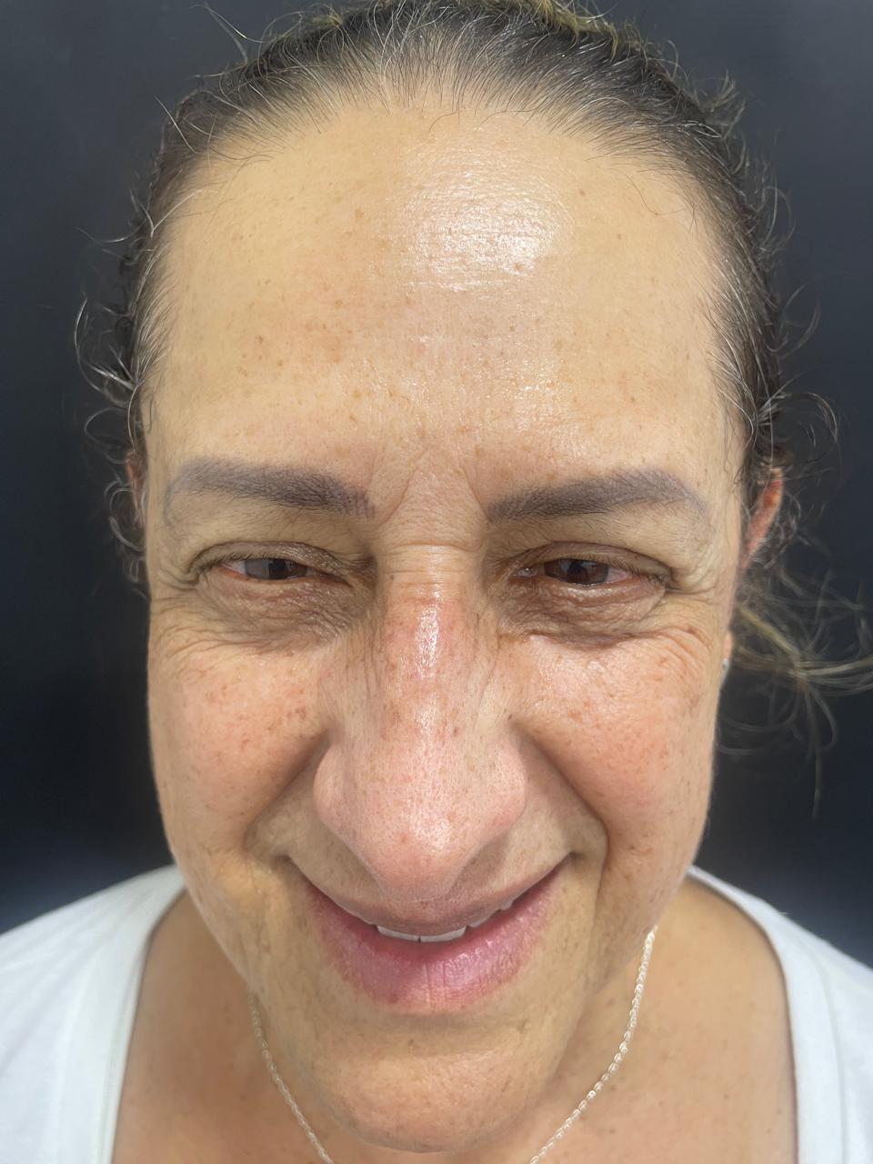 Antes de Botox en arrugas de la nariz RyV Dental
