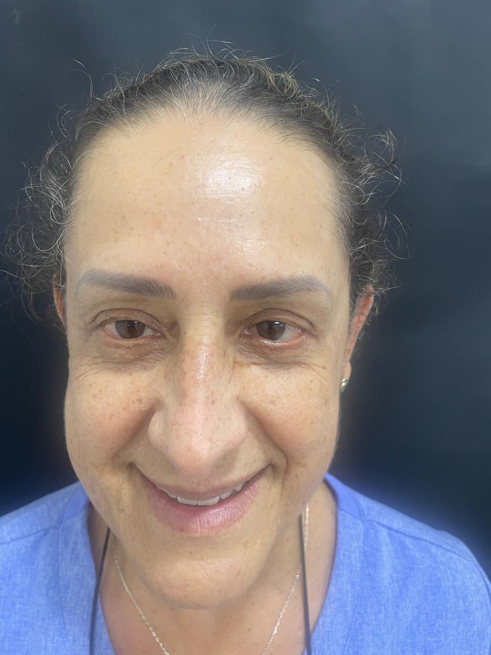 Después de Botox en arrugas de la nariz RyV Dental