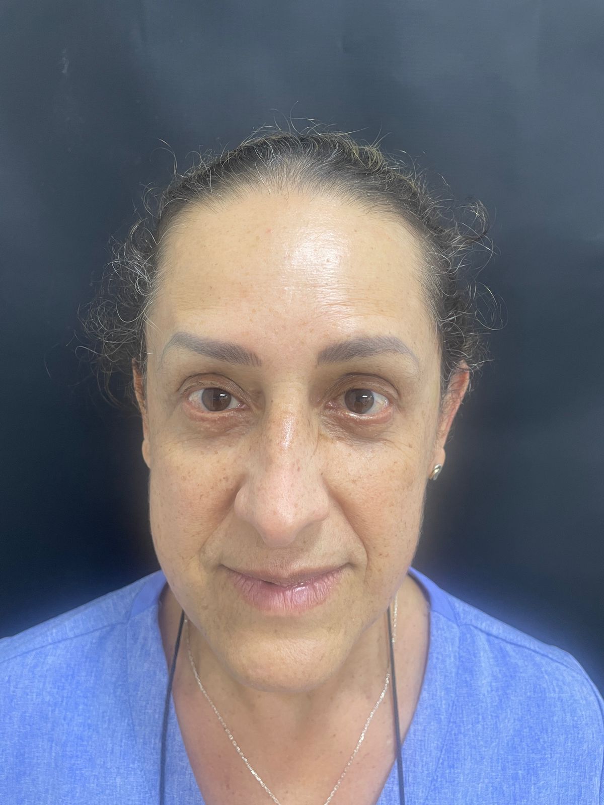 Después de Botox en arrugas de la frente RyV Dental
