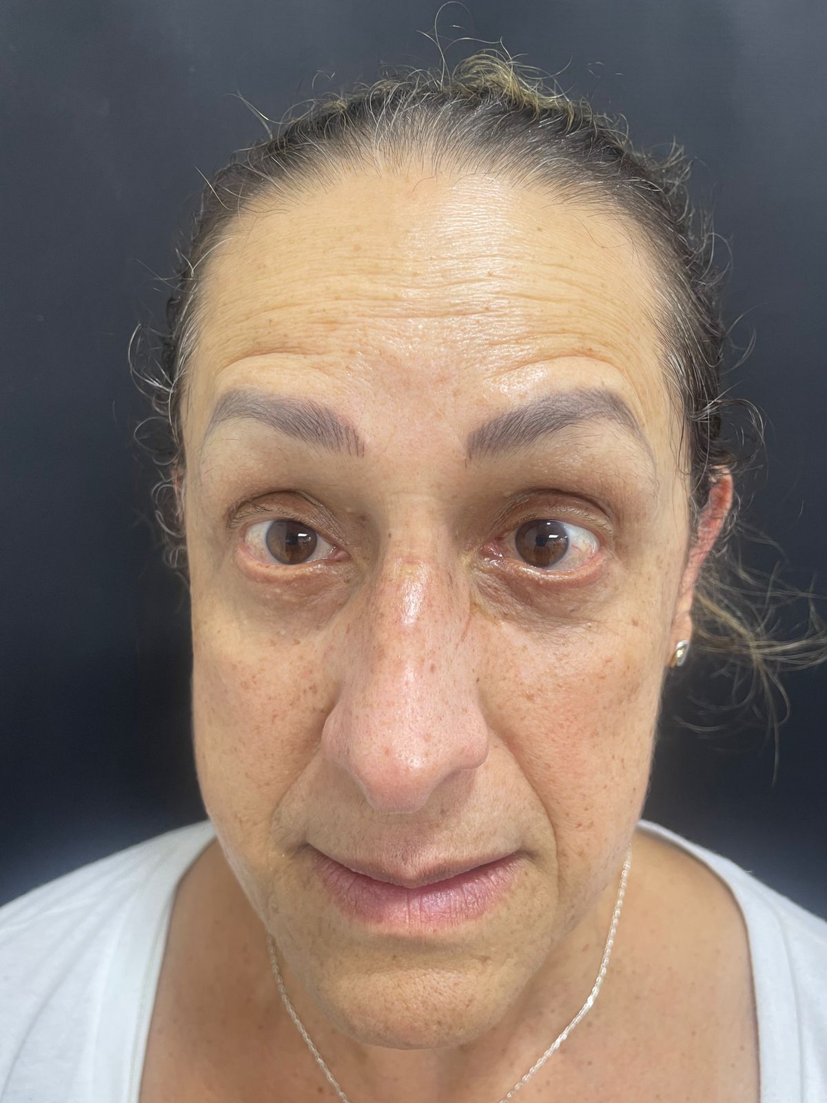 Antes de Botox en arrugas de la frente RyV Dental