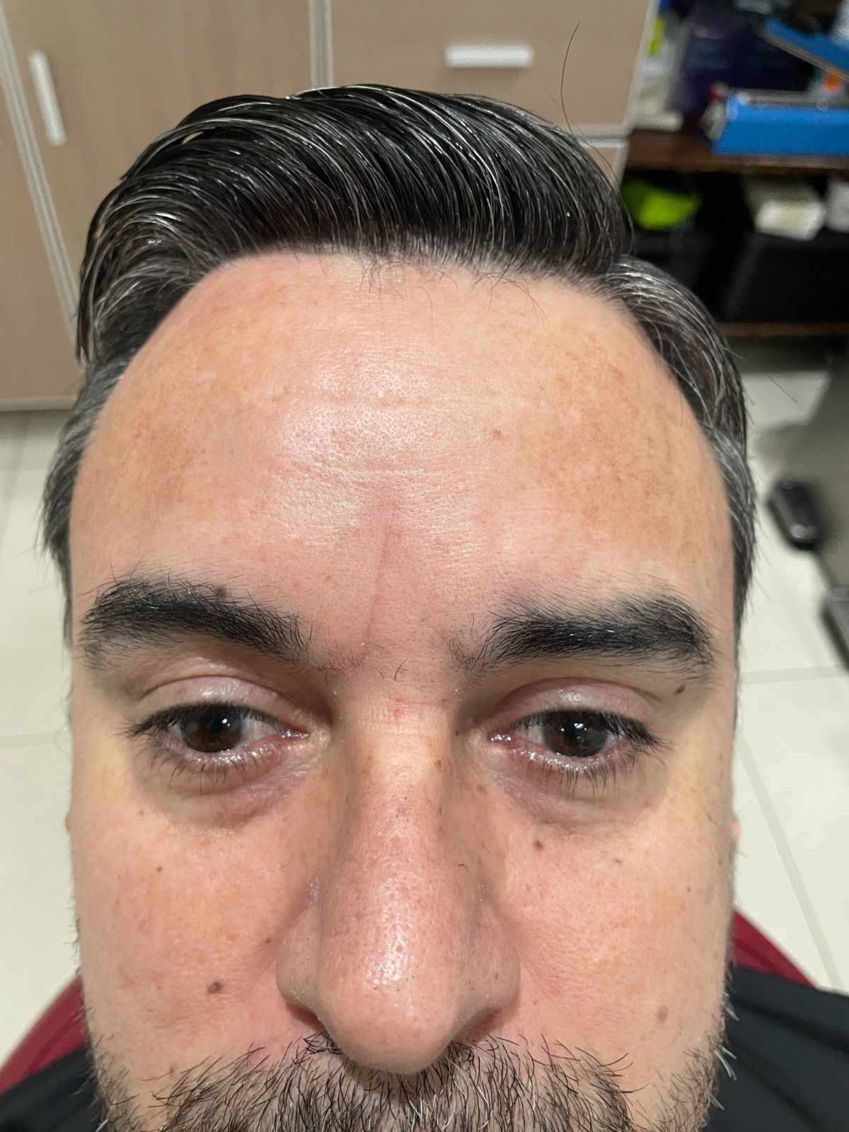 Después de Botox frente RyV Dental