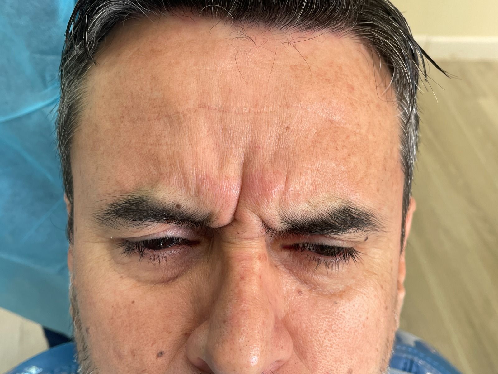 Antes de Botox frente RyV Dental