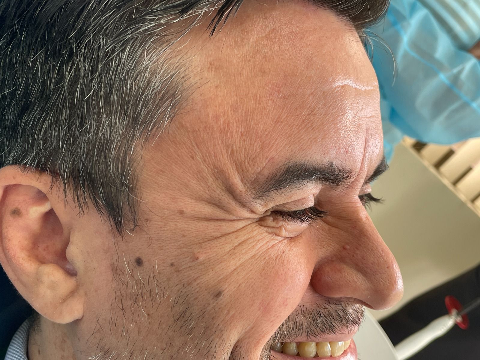 Antes de tratamiento Botox patas de gallo RyV Dental